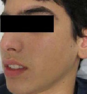 acné apres 3 traitement de l'acné
